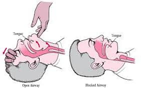 ADULT AIRWAY MANAGEMENT