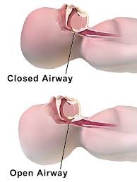 INFANT AIRWAY MANAGEMENT